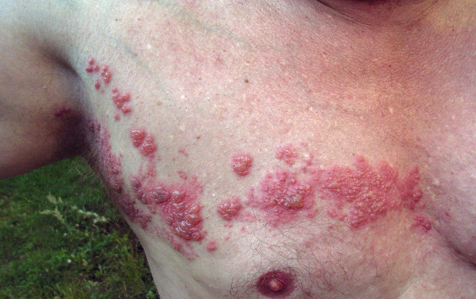 Herpes Facts - Herpes Virus Herpes Facts - Herpes Virus